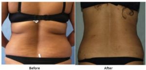 What is the difference between body contouring and liposuction