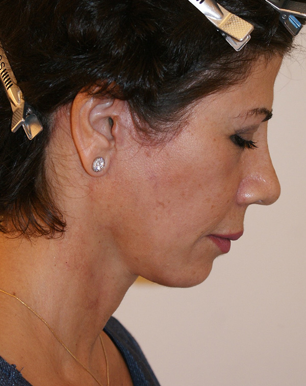 Photo of Patient 07 After Facial Fat Transfer Procedure